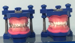 O DENTISTA DEVE SOLICITAR O TIPO DE TYPODONT CLASSE I C/4 EXTRAÇÕES, CLASSE II COM AP DENTÁRIO INFERIOR SUAVE,EXTRAÇÕES ASSIMÉTRICA OU CLASSE COM DUAS EXTRAÇÕES INFERIORES DE 1ªS PRÉ-MOLARES.